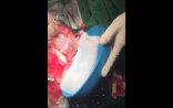 Bakıda 7 yaşlı qızın başından gigant kist çıxarılıb - VİDEO